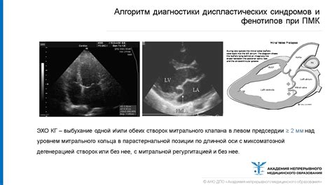 Диагностика удлиненного евстахиева клапана