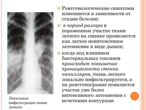 Диагностика уплотнения правого корня легкого