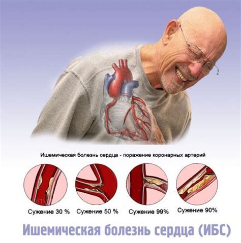 Диагностика уплотнения сердечной артерии