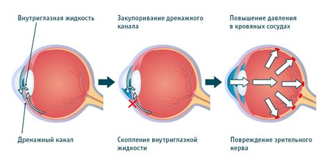 Диагностика уровня глазного давления 21