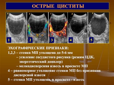 Диагностика усиления сосудистого рисунка щитовидной железы