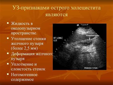 Диагностика утолщения стенки желчного пузыря