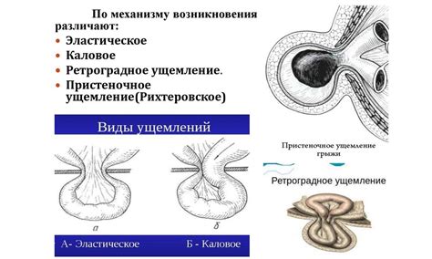 Диагностика ущемленной грыжи