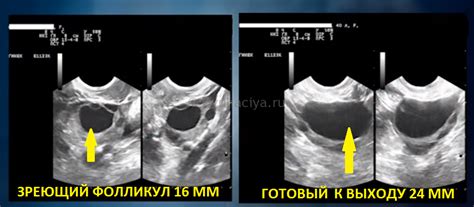 Диагностика фолликула размером 17 мм