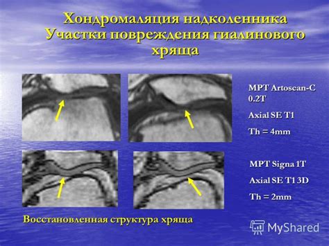 Диагностика хондромаляции надколенника 3 степени