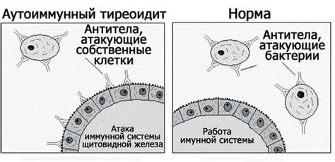 Диагностика хронического аутоиммунного тиреоидита эутиреоза