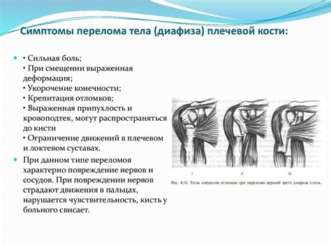 Диагностика частично консолидированного перелома