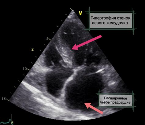 Диаметр стенок левого желудочка