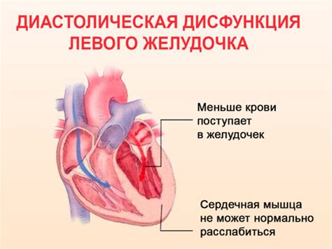 Диастолическая дисфункция левого желудочка у детей: особенности и лечение