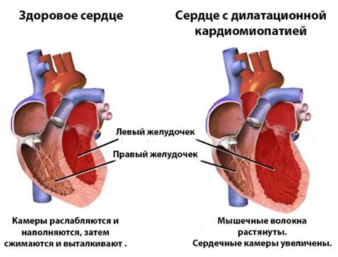 Дилатационная кардиомиопатия