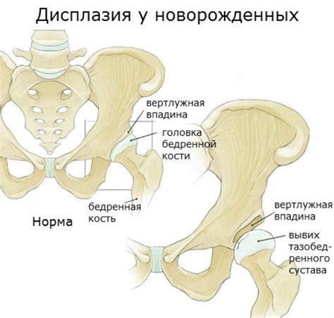 Дисплазия