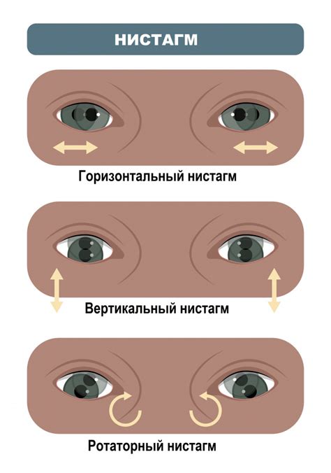 Дифференциальный диагноз горизонтального нистагма