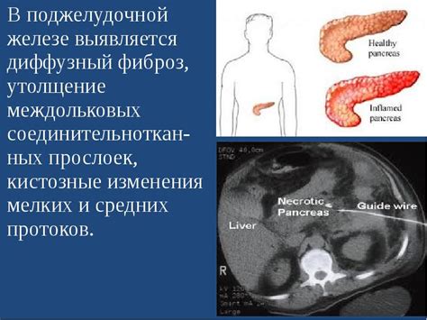 Диффузные изменения поджелудочной железы: общая информация