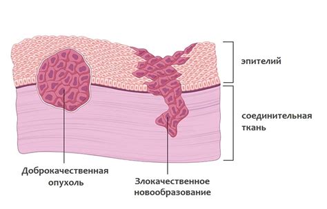 Доброкачественные опухоли