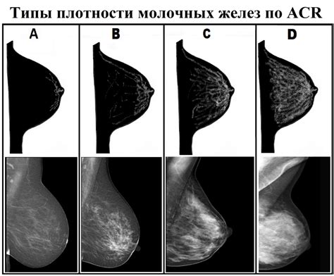 Дополнительные методы диагностики смешанного типа строения молочных желез