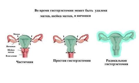 Доступные методы гистерэктомии матки