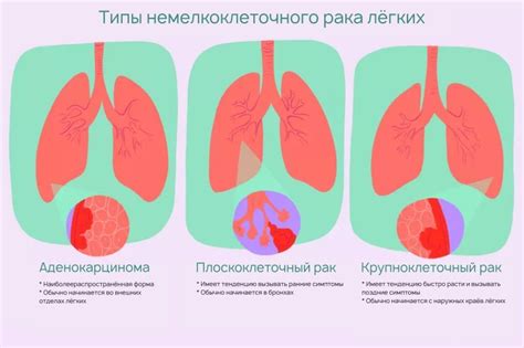 Другие проявления немелкоклеточного рака