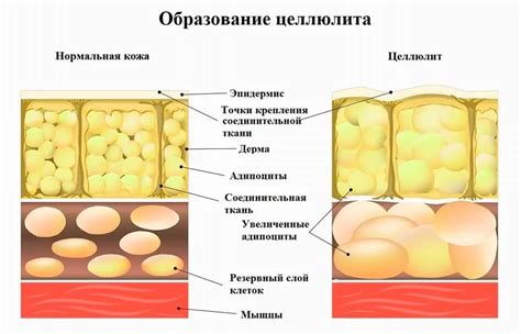 Желтый целлюлит: причины, симптомы, методы борьбы