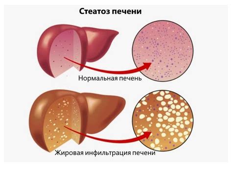 Жировая дистрофия печени: одна из основных причин повышения эхогенности