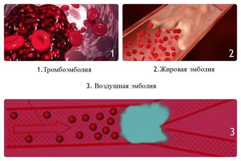 Жировая эмболия: опасное состояние организма