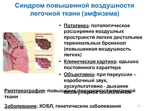 Заболевания, вызывающие патологическое расширение корней легких