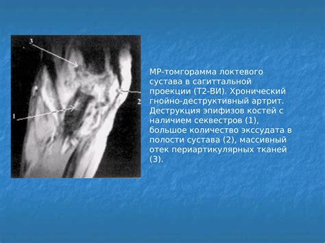 Заболевания костно-суставной системы как фактор, приводящий к появлению шишек на сгибе руки