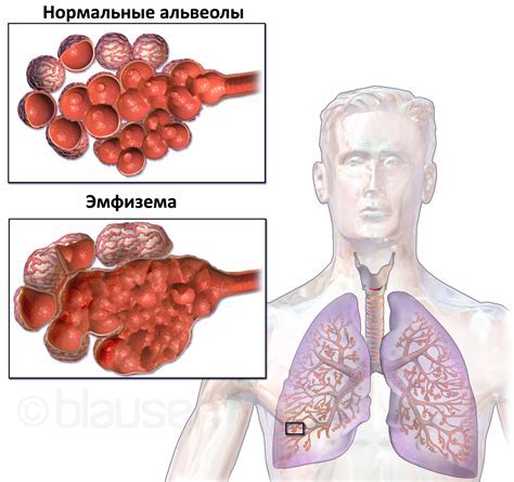 Заболевания легких: основные причины и симптомы