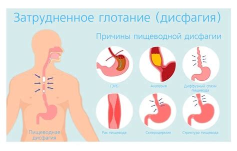 Заболевания пищевода, вызывающие затруднение при глотании