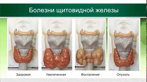 Заболевания щитовидной железы и нервной системы