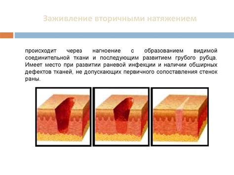 Заживление ран и ускорение процесса регенерации кожи с помощью натрия хлорида