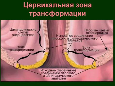 Закрытый цервикальный канал: