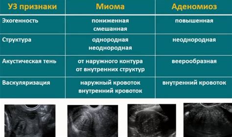 Затрудненная визуализация миометрия