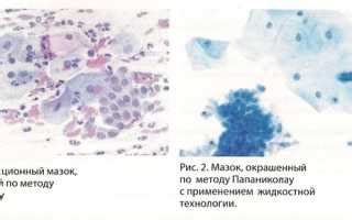 Зачем нужен посев мазка