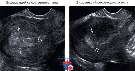 Здоровье женщины и нечеткий контур эндометрия: взаимосвязь