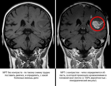 Значение МРТ головного мозга с контрастом