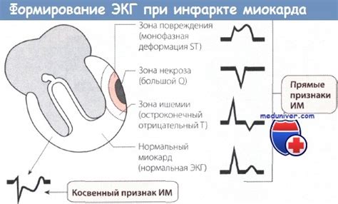 Значение аномального зубца Q