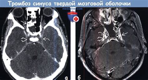 Значение ассиметрии поперечного синуса в диагностике заболеваний