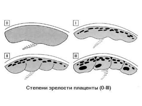 Значение зрелости плаценты 1 степени