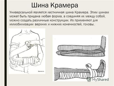 Значение иммобилизации сустава