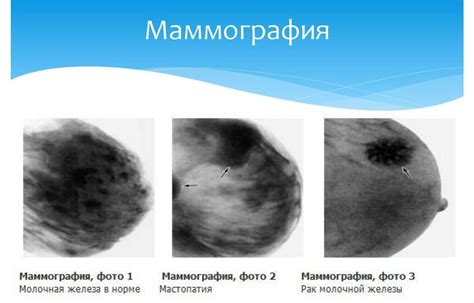 Значение и методы маммографии