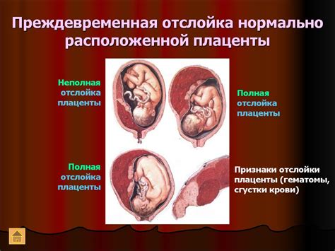 Значение и роль высоко расположенной плаценты во время беременности