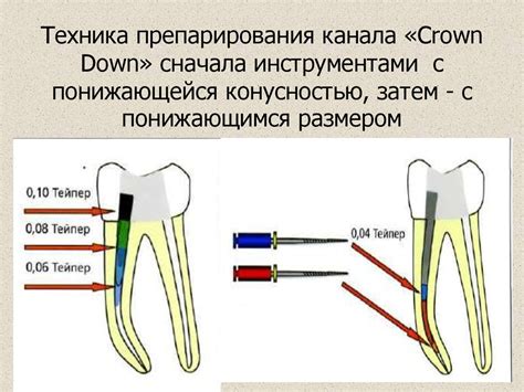 Значение конусности для заполнения корневого канала