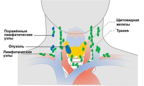 Значение лимфоузлов для щитовидной железы