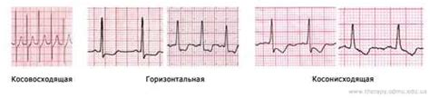 Значение неспецифического изменения сегмента ST