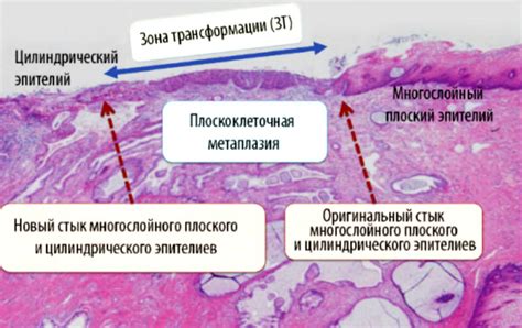 Значение онкоцитологии в диагностике рака плоского эпителия