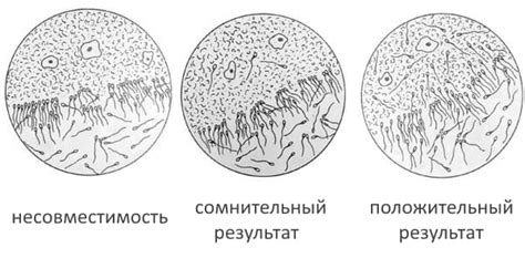 Значение отрицательного теста Шуварского