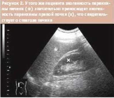 Значение повышенной эхогенности лимфоузлов