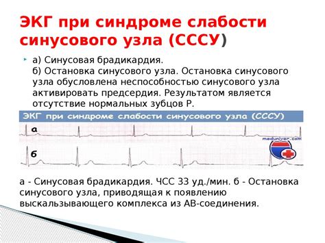 Значение положения ЭОС в синусовом ритме