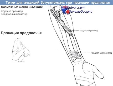 Значение пронации предплечья