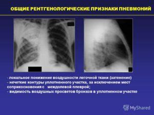 Значение сохраненной пневматизации легочной ткани для здоровья